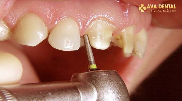 Mài răng bọc sứ có phải là kỹ thuật bắt buộc trong nha khoa thẩm mỹ?