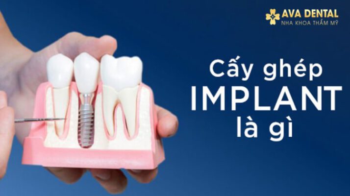 Trồng răng Implant là gì