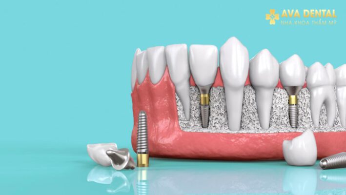 Trồng răng Implant thời gian bao lâu