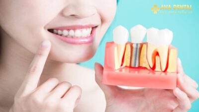 Ưu và nhược điểm của Trồng răng Implant - NHA KHOA AVA
