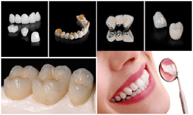 Khám phá về các loại răng sứ