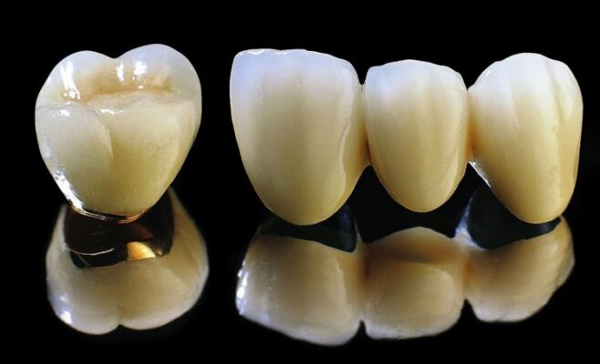 Răng sứ titan là gì