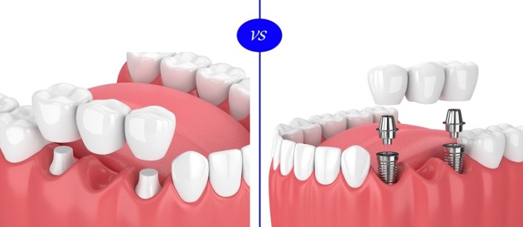 Trồng Răng Implant và Bọc Răng Sứ