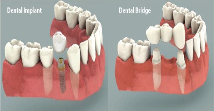 trồng răng Implant và cầu răng sứ
